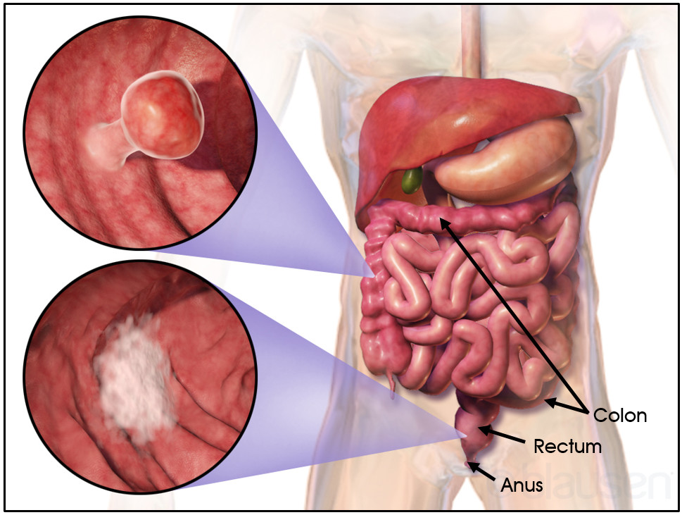 how long can you live with stage 4 pancreatic and liver cancer