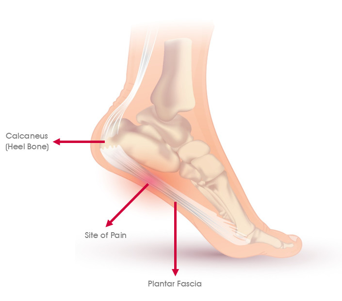 Occupational Plantar Fasciitis Claims 