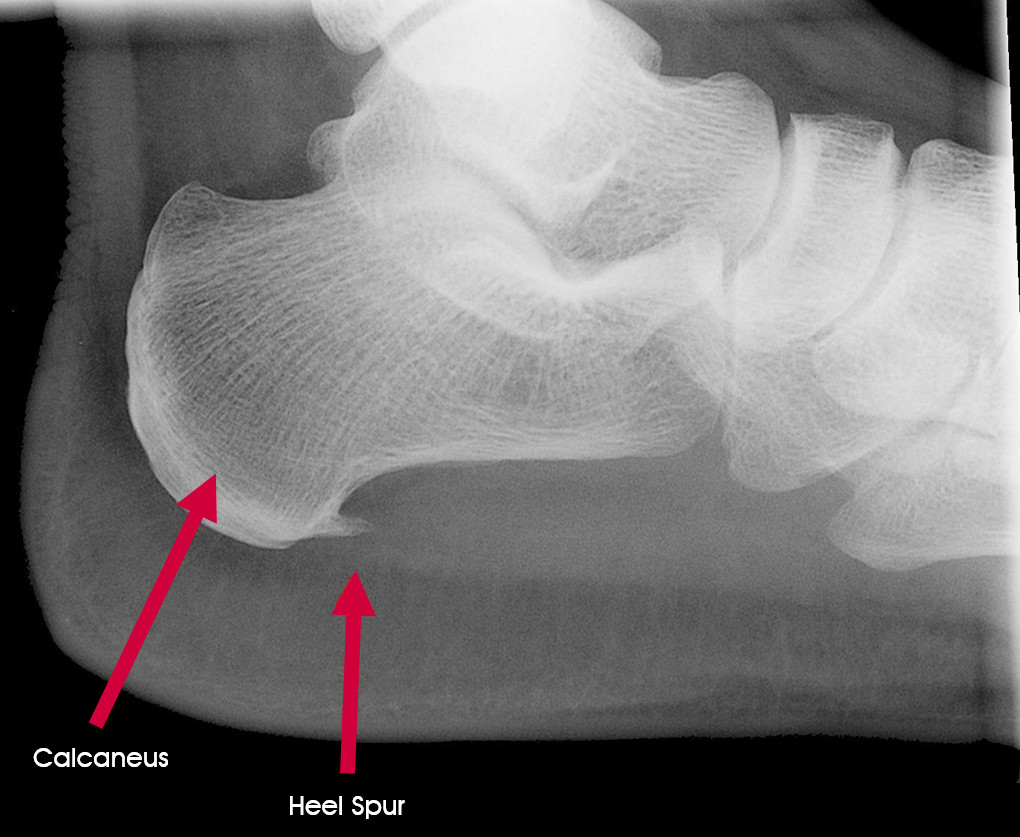 calcaneal spur patient uk
